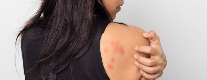 Side Effects of ALDIGESIC P TABLET: Skin rash