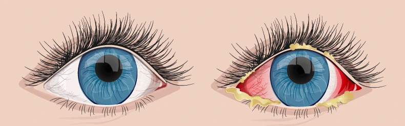Pink eye, or conjunctivitis